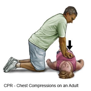 Chest Compression on an Adult
