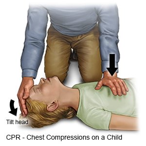 Chest Compressions on a Child