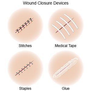 Do I Need Stitches? Should I use Liquid Stitches? – Save Rite Medical