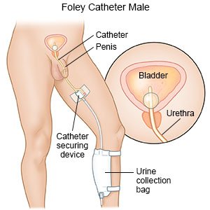 how long should a man have a catheter