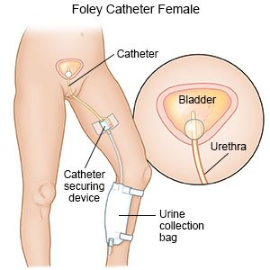 How Does A Catheter Work? | Bladder & Bowel Community