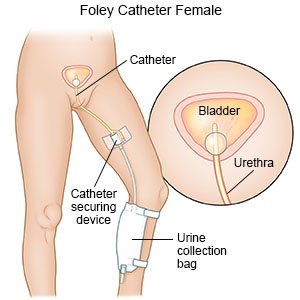 What is a catheter valve? A handy guide to using a catheter valve  effectively