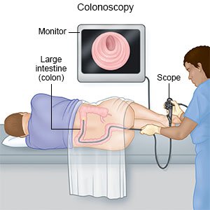 Image result for Colonoscopy