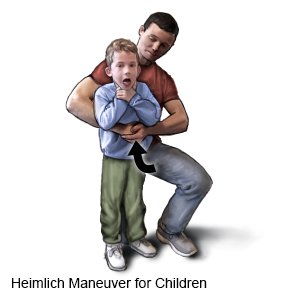 Heimlich Maneuver for Children