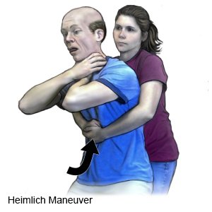 Heimlich Maneuver Adult