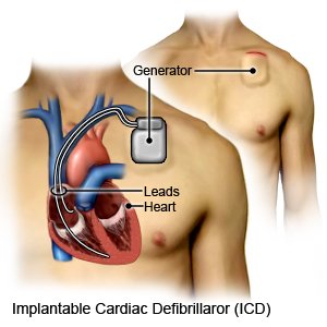 Implantable Cardiac Defibrillator (ICD)