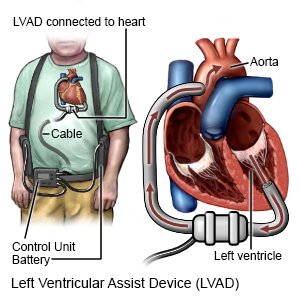 Left Ventricular Assist Device (LVAD)