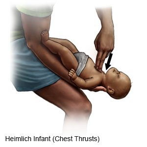Heimlich Infant (Chest Thrusts)
