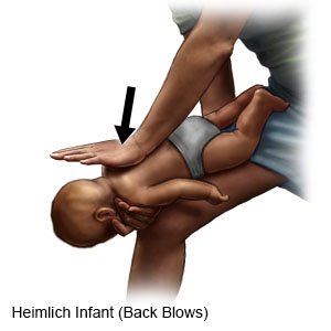Heimlich Infant (Back Blows)
