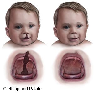 Cleft Palate Repair 