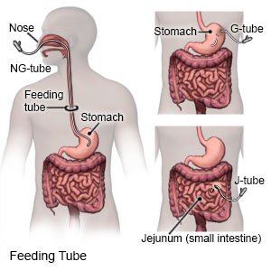 Feeding Tube