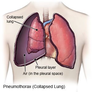 pneumothorax traumatic