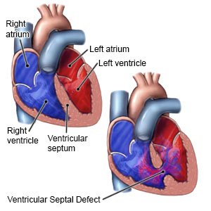 Ventricular Septal Defect