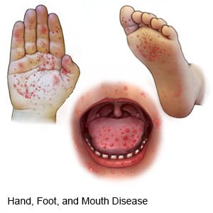 Hand Foot Mouth Disease