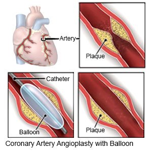 Coronary Artery Angioplasty (Balloon)