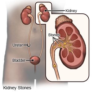 How to tell if deals you have kidney stones