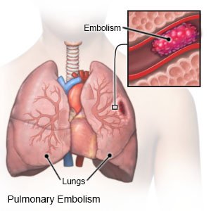 Plicní embolie