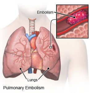 Pulmonary Embolism