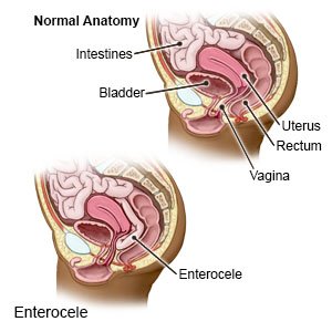 Anterior and Posterior Repair - Cherokee Women's Health