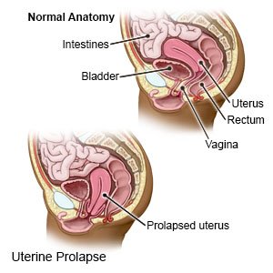 Uterine Prolapse - What You Need to Know