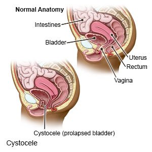 Cystocele - What You Need to Know