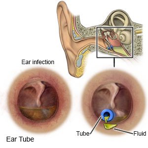 Myringotomy PE Tubes in Children (Discharge