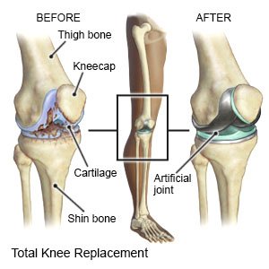 Total Knee Replacement