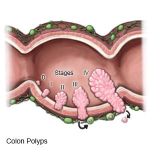 Cancer colon polyps Cancer colon polyps