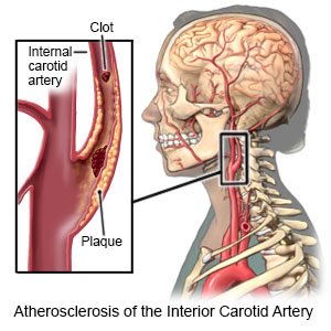 Atherosclerosis of the Interior Carotid Artery