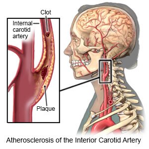 Carotid Artery Disease What You Need To Know