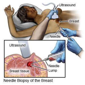 Needle Biopsy of the Breast