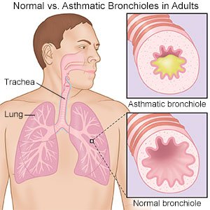 Normal vs Asthmatic Bronchioles Adult