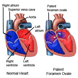 Patent Foramen Ovale