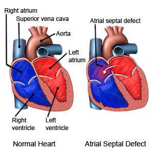 Atrial Septal Defect