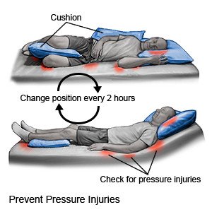 Prevent Pressure Injuries