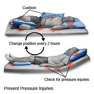 Wheelchair seat cushion options to reduce risks of pressure damage