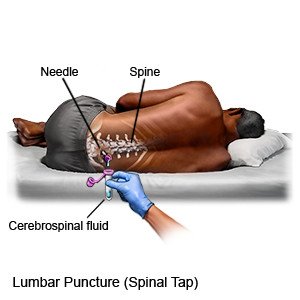 Lumbar Puncture Adult