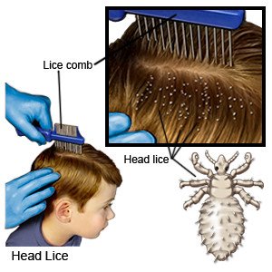 Head Lice in Children - What You Need to Know