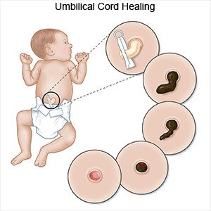 Umbilical Cord Healing