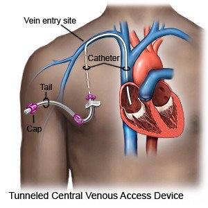 Tunneled Central Venous Access Device