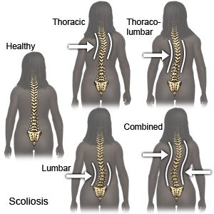 Scoliosis