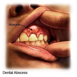 Dental Abscess