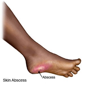 Skin Abscess