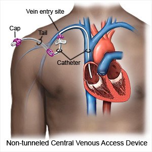 Non-Tunneled Central Venous Access Device