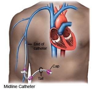 Midline Catheter
