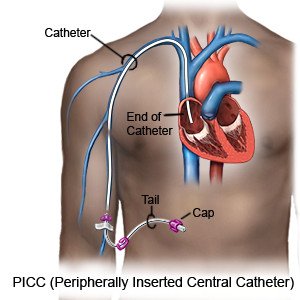 PICC (Peripherally Inserted Central Catheter)