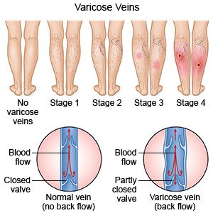 Varicose Veins - What You Need to Know