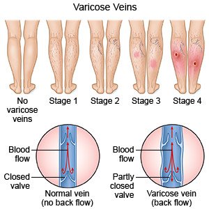 stripping varicoza)