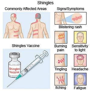 Shingles