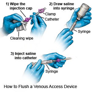 How to Flush a Venous Access Device